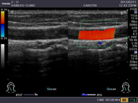 頸動脈超音波検査